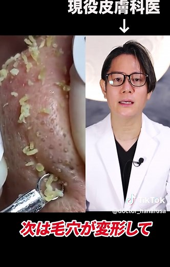 角栓除去方法は正しい？現役皮膚科医が解説