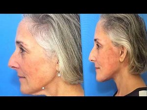 Ricki Lake Shares DRAMATIC Facelift Before and After