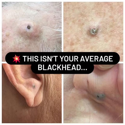 Benson Esthetics | 🖤 Giant Blackheads? Let’s Talk About the Dilated Pore of Winer! 👀 We’ve all seen blackheads before — but every once in a while, there’s... | Instagram