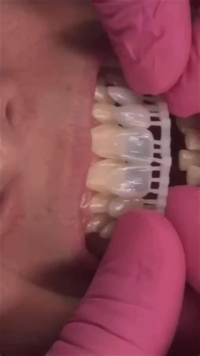 Wally Renne | The MOD Institute on Instagram: "So many people reached out about this workflow. The workflow is actually simple and that’s the whole point. It’s linear, predictable, and patient led. It starts with a real conversation: what the patient wants, what they need, what we can correct with minimal-to-no prep, and what we can’t correct without a serious tradeoff. Sometimes the “perfect” midline or a dramatic perfection is absolutely possible… but it comes with aggressive tooth reduction o