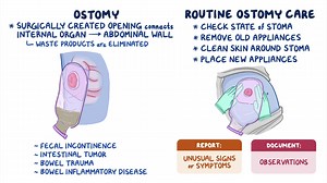 Video: Hygiene - Ostomy care: Nursing skills - Video Explanation! | Osmosis | Osmosis