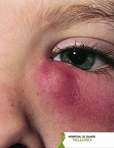DACRIOCISTITE | HOSPITAL DE OLHOS VELLOSO