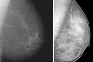 FDA aims to level field on breast-density disclosure to patients - UW Medicine | Newsroom