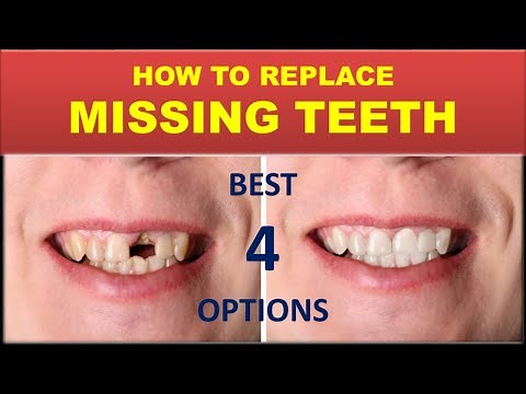 How to replace missing teeth | teeth replacement options by Dr Rohan virani- cosmetic dentist
