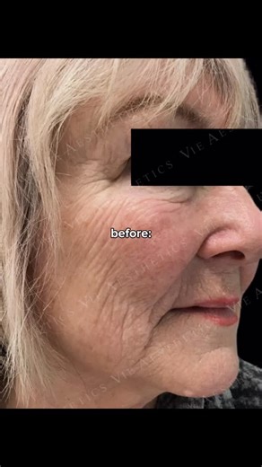 Vie Aesthetics | The power of polynucleotides ✨ Polynucleotides support skin quality from within by helping improve hydration, elasticity, and overall skin... | Instagram