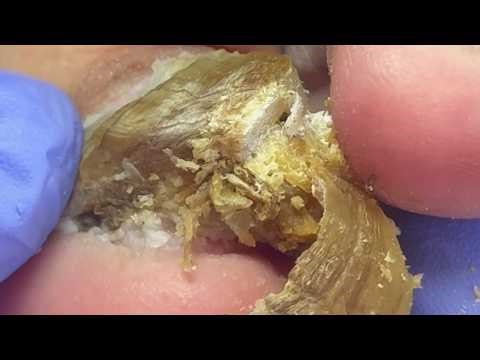 How To Remove Super Thick Onychomycosis Step By Step【Pedicure King】