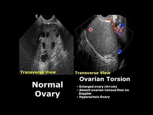 Ovary Ultrasound Normal Vs Abnormal Image Appearances | Ovarian Pathologies On USG