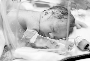 Edwards Syndrome in Infants – Reasons, Symptoms & Treatment