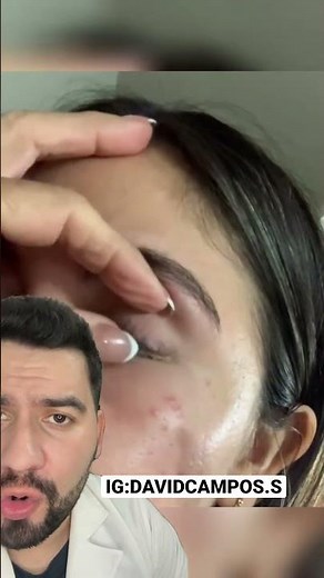 APPLYING TERRAMYCIN CREAM TO THE EYE
