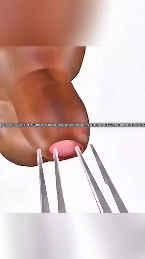 Understanding Prepex Circumcision Benefits and Process