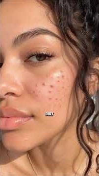 Steps to take to avoid pimple breakouts #pimpletreatments #acnetreatment