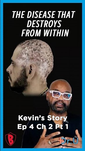Dissecting Cellulitis Explained | Kevin’s Bumpinator Journey Part 1