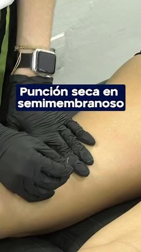 Dry Needling in the Semimembranosus Muscle: Step-by-Step Technique for Treating Hamstrings