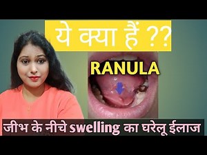 Below tongue swelling/salivary gland stone/sialothiasis/treatment of RANULA जीभ के नीचे swelling
