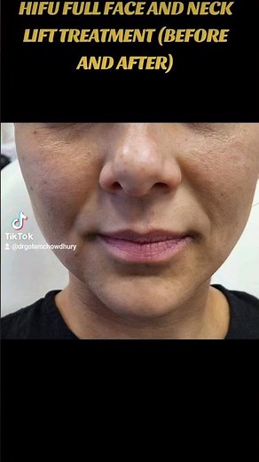 HIFU FULL FACE AND NECK TREATMENT (BEFORE AND AFTER). #botox #hifu #botoxfiller #lipenhancement #prp