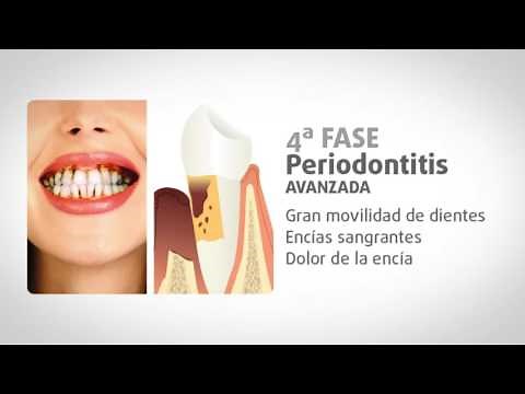 Evolución y fases de la periodontitis