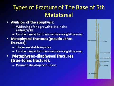 base of the 5th metatarsal fracture
