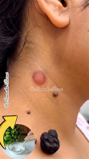 💯Warts & Skin Tags Remove/DIY Tips For Mole & Warts Removal #shorts #warts #moles #skintags #viral