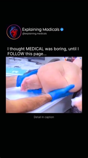 Medical | Health | Anatomy on Instagram: "Elephantiasis is a severe and chronic condition caused by long-term damage to the lymphatic system, the network responsible for draining excess fluid and supporting immune defense. When lymph vessels become blocked most commonly due to parasitic infection by filarial worms transmitted through mosquito bites fluid builds up in tissues instead of being drained away. Over time, this constant fluid accumulation triggers inflammation, thickening of the skin, 