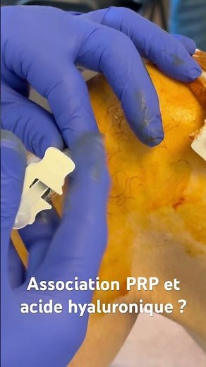 PRP and hyaluronic acid injection in knee osteoarthritis