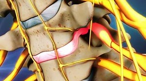 This video shows how a disc in the neck can herniate, or leak, and cause symptoms of neck pain and arm pain. Learn more: http://bit.ly/20dUYl9 | Spine-health