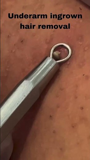 how remove underarm blackheads | how to remove underarm ingrown hair | ingrown hair | change my life