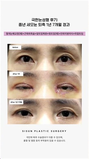 극한눈성형 후기: 중년 세모눈 퇴축 1년 7개월 경과 #시선성형외과 #shrots