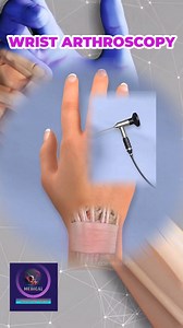 Wrist Joint Pain | Diagnosing and Treatment | Wrist Arthroscopy Procedure | Medical Animation Media