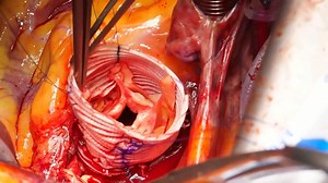 M - The David procedure for quadricuspid aortic valve repair