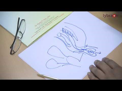 What is Rectal Prolapse and How It Will Be Cured By Dr. Pravin Gore || Lybrate