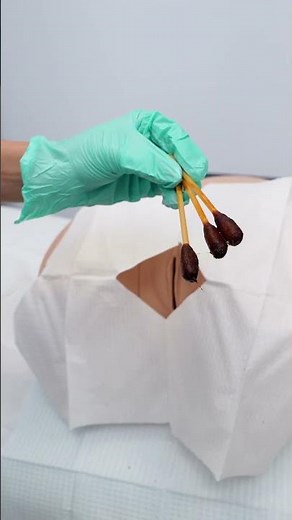 Insert the catheter another 1-2 inches before inflating to make sure you are in the bladder #foley