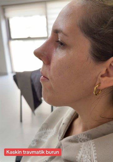 #drelvin #travmati #rinoplastika #kesfet