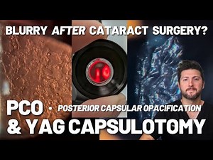 Explained: PCO & YAG Laser Capsulotomy