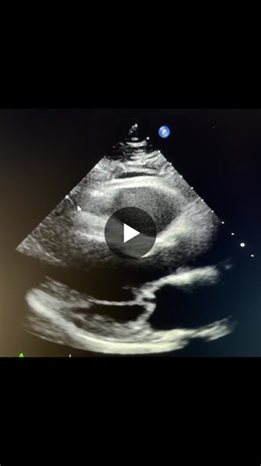 Severe mitral regurgitation (MR) caused by a flail of the posterior mitral leaflet (PML) is a significant clinical finding. In the world of cardiology, flail is a step beyond simple prolapse; it… | Andrea Marcenó