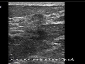 CASE 493 Left upper outer breast intramammary lymph node