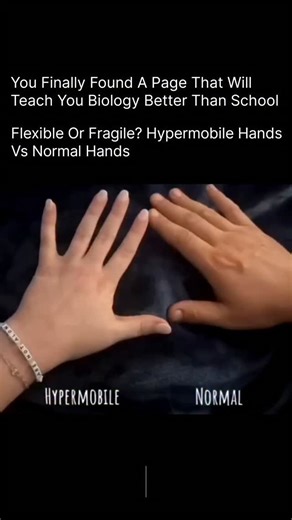BIOLOGY | MEDICAL | HEALTH | Some hands can bend way beyond normal limits — looks cool, right? But there’s more beneath the surface 👇 🖐️ Normal Hands Joints move... | Instagram