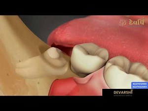 DISIMPACTION/ IMPACTED WISDOM TOOTH REMOVAL/ 3RD MOLAR EXTRACTION