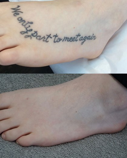Tattoo Removal