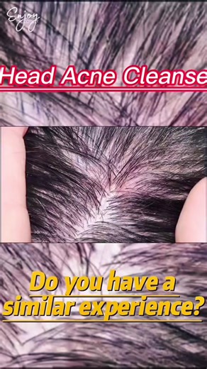 Scalp Acne Extraction | ASMR Pimple Popping on Head