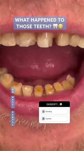 GRINDING, CAVITIES OR SMOKER?