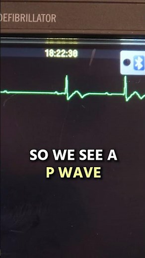 2nd Degree Type I HEART BLOCK