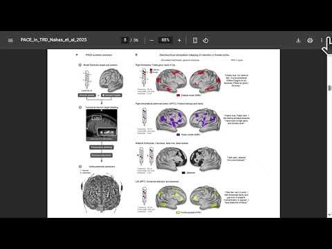 Adaptive Cortical Stimulation for TRD: Personalized Mapping, Bayesian Tuning, and Real Limits