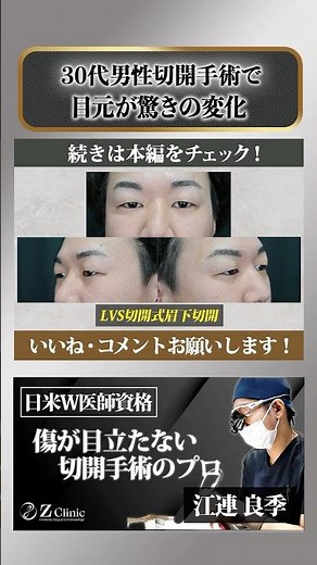 【眉下切開＋眼輪筋切除】で若い人でもメイクなしで傷跡がまるで見えない！施術のヒミツを大公開！