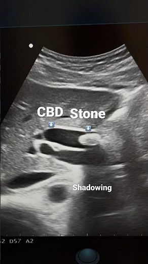 CBD Stone Ultrasound | #Sonography #ardms #abdomen #medicine