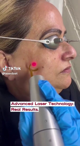 PicoWay Dark Spot Removal for Flawless Skin