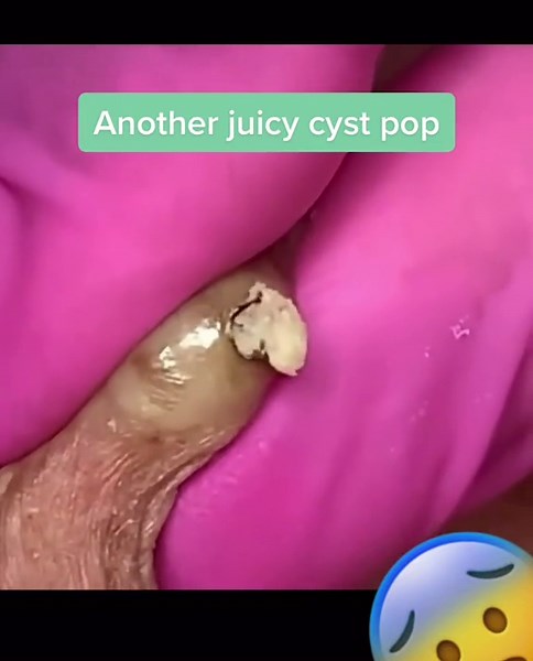 Juicy cyst pop. #cyst #cystpopping #pimpepop #oddlysatisfying #skincare #blackheadsremoval #whiteheadremoval