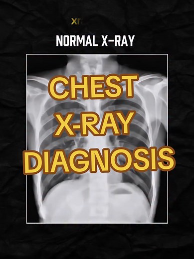 ☢️🫁Chest X-ray diagnosis #creatorsearchinsights #lungs #chest #xraytech #xraystudent #xray