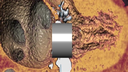Getting the Full Picture: How Advanced Imaging Refines Management of Mitral Valve Disease