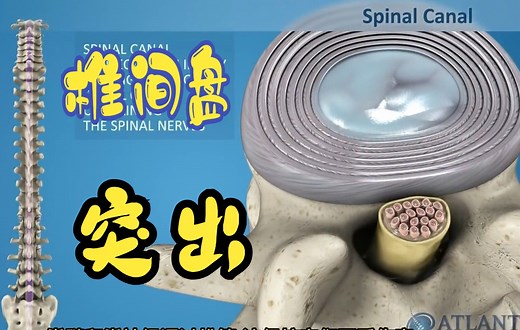 椎间盘突出的解剖学基础与临床