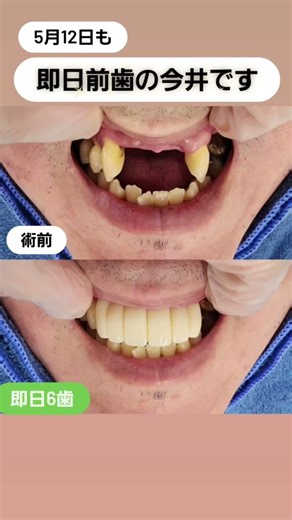 数日前に他院様で抜歯をして入れ歯をセットしたのですが入れ歯の異物感が強くつけられない状況でした。即日6歯仮歯で美しくしていきました #セラミック